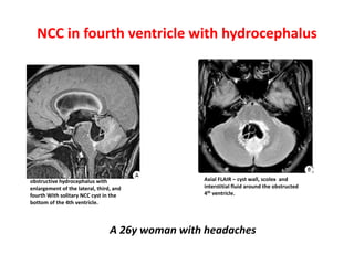 NCC in fourth ventricle with hydrocephalus
obstructive hydrocephalus with
enlargement of the lateral, third, and
fourth With solitary NCC cyst in the
bottom of the 4th ventricle.
Axial FLAIR – cyst wall, scolex and
interstitial fluid around the obstructed
4th ventricle.
A 26y woman with headaches
 