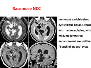 Racemose NCC
numerous variable-sized
cysts fill the basal cisterns
with hydrocephalus, with
mild/moderate rim
enhancement around the
"bunch of grapes" cysts
 