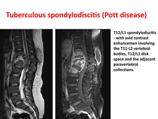 Tuberculous spondylodiscitis (Pott disease)
T12/L1 spondylodiscitis
- with avid contrast
enhancemen involving
the T11-L2 vertebral
bodies, T12/L1 disk
space and the adjacent
paravertebral
collections.
 