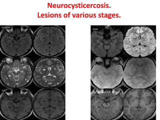 Neurocysticercosis.
Lesions of various stages.
 