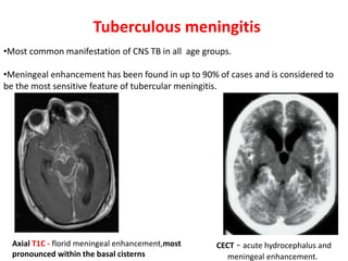 Tuberculous meningitis
Axial T1C - florid meningeal enhancement,most
pronounced within the basal cisterns
•Most common manifestation of CNS TB in all age groups.
•Meningeal enhancement has been found in up to 90% of cases and is considered to
be the most sensitive feature of tubercular meningitis.
CECT - acute hydrocephalus and
meningeal enhancement.
 