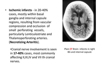 • Ischemic infarcts - in 20-40%
cases, mostly within basal
ganglia and internal capsule
regions, resulting from vascular
compression and occlusion of
small perforating vessels,
particularly Lenticulostriate and
Thalamoperforating arteries.
(Necrotizing Arteritis).
Plain CT Brain- infarcts in right
BG and internal capsule
•Cranial nerve involvement is seen
in 17-40% cases, most commonly
affecting II,III,IV and VII th cranial
nerves.
 