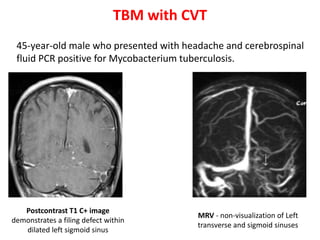 TBM with CVT
Postcontrast T1 C+ image
demonstrates a filing defect within
dilated left sigmoid sinus
45-year-old male who presented with headache and cerebrospinal
fluid PCR positive for Mycobacterium tuberculosis.
MRV - non-visualization of Left
transverse and sigmoid sinuses
 