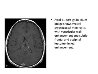 • Axial T1 post-gadolinium
image shows typical
cryptococcal meningitis
with ventricular wall
enhancement and subtle
frontal and occipital
leptomeningeal
enhancement.
 