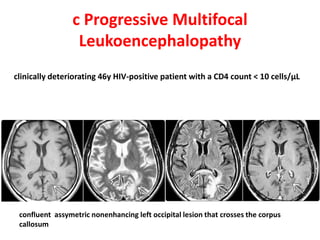 c Progressive Multifocal
Leukoencephalopathy
clinically deteriorating 46y HIV-positive patient with a CD4 count < 10 cells/μL
confluent assymetric nonenhancing left occipital lesion that crosses the corpus
callosum
 