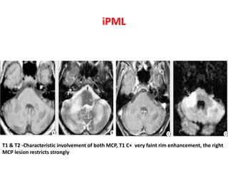 iPML
T1 & T2 -Characteristic involvement of both MCP, T1 C+ very faint rim enhancement, the right
MCP lesion restricts strongly
 