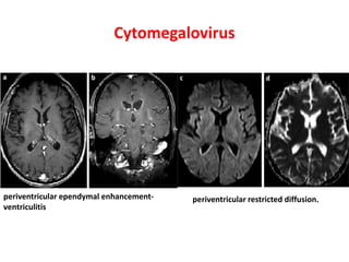 Cytomegalovirus
periventricular ependymal enhancement-
ventriculitis
periventricular restricted diffusion.
 