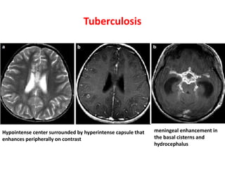 Tuberculosis
Hypointense center surrounded by hyperintense capsule that
enhances peripherally on contrast
meningeal enhancement in
the basal cisterns and
hydrocephalus
 