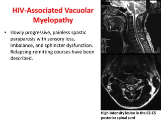 HIV-Associated Vacuolar
Myelopathy
• slowly progressive, painless spastic
paraparesis with sensory loss,
imbalance, and sphincter dysfunction.
Relapsing-remitting courses have been
described.
High-intensity lesion in the C2-C5
posterior spinal cord
 