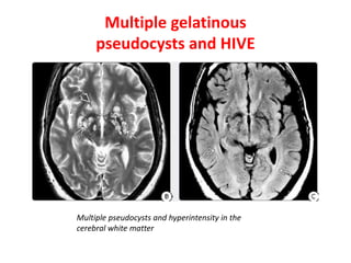 Multiple gelatinous
pseudocysts and HIVE
Multiple pseudocysts and hyperintensity in the
cerebral white matter
 