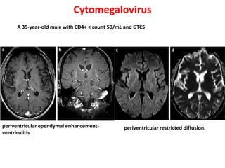 Cytomegalovirus
periventricular ependymal enhancement-
ventriculitis
periventricular restricted diffusion.
A 35-year-old male with CD4+ < count 50/mL and GTCS
 