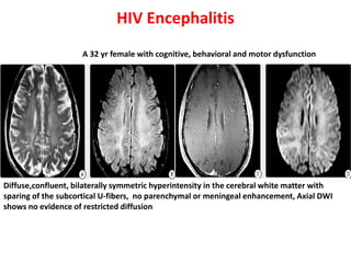 HIV Encephalitis
Diffuse,confluent, bilaterally symmetric hyperintensity in the cerebral white matter with
sparing of the subcortical U-fibers, no parenchymal or meningeal enhancement, Axial DWI
shows no evidence of restricted diffusion
A 32 yr female with cognitive, behavioral and motor dysfunction
 