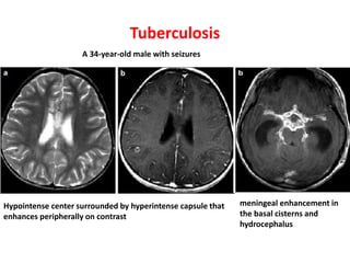 Tuberculosis
Hypointense center surrounded by hyperintense capsule that
enhances peripherally on contrast
meningeal enhancement in
the basal cisterns and
hydrocephalus
A 34-year-old male with seizures
 