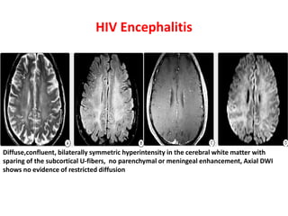 HIV Encephalitis
Diffuse,confluent, bilaterally symmetric hyperintensity in the cerebral white matter with
sparing of the subcortical U-fibers, no parenchymal or meningeal enhancement, Axial DWI
shows no evidence of restricted diffusion
 