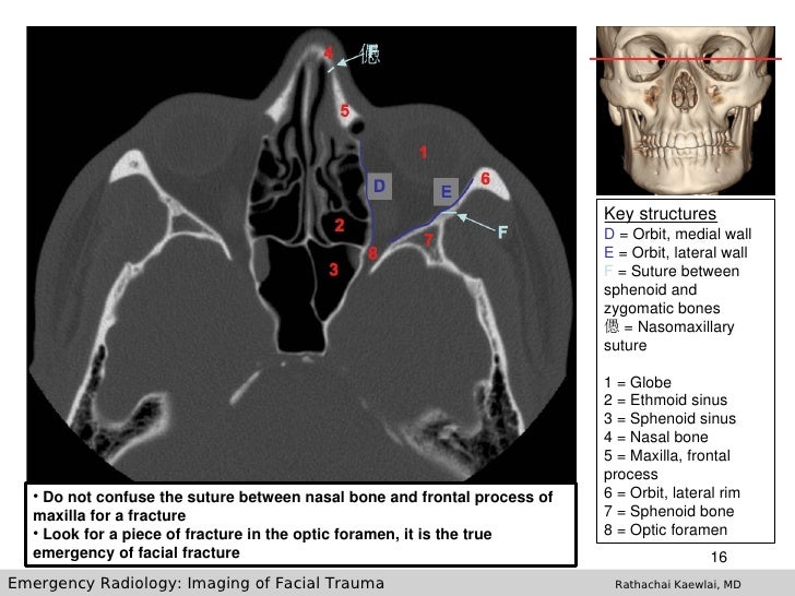 Imaging Of Facial Trauma Part 1