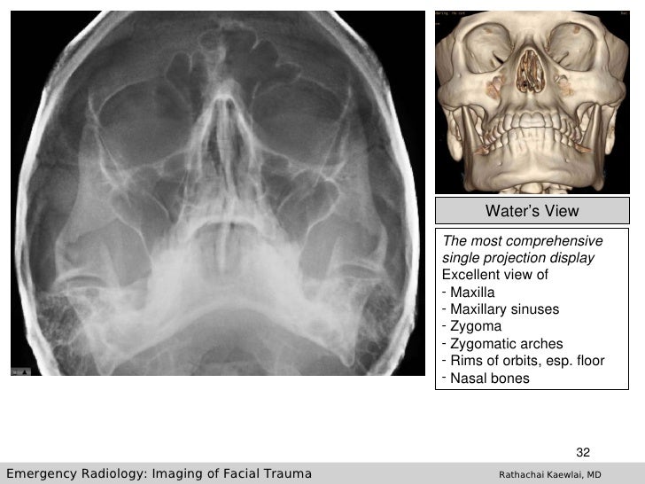 Imaging Of Facial Trauma Part 1