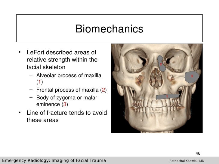 Imaging Of Facial Trauma Part 1