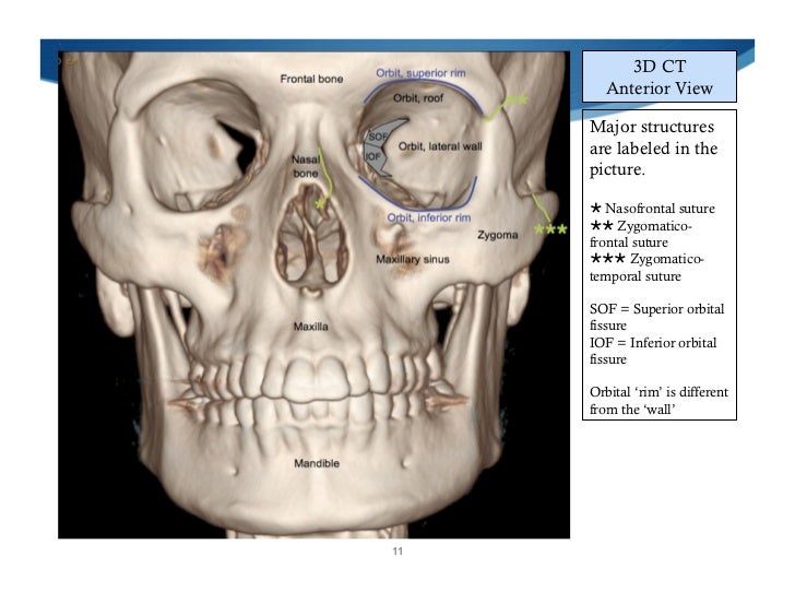 Imaging Of Facial Trauma Part 1