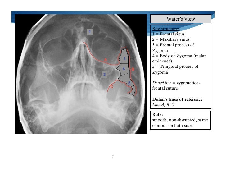 Imaging Of Facial Trauma Part 2