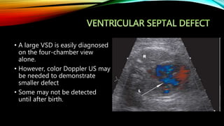 • Gray scale and Doppler image Four chamber
view of fetal heart show a defect in proximal
part of VSD with right to left f...