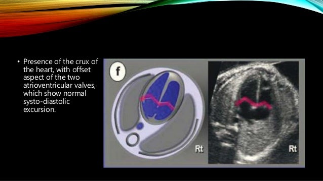 baby heart doppler cvs