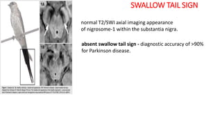 SWALLOW TAIL SIGN
normal T2/SWI axial imaging appearance
of nigrosome-1 within the substantia nigra.
absent swallow tail sign - diagnostic accuracy of >90%
for Parkinson disease.
 