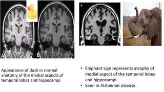 Appearance of duck in normal
anatomy of the medial aspects of
temporal lobes and hippocampi
• Elephant sign represents atrophy of
medial aspect of the temporal lobes
and hippocampi
• Seen in Alzheimer disease.
 
