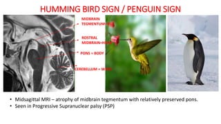 HUMMING BIRD SIGN / PENGUIN SIGN
• Midsagittal MRI – atrophy of midbrain tegmentum with relatively preserved pons.
• Seen in Progressive Supranuclear palsy (PSP)
MIDBRAIN
TEGMENTUM=BILL
ROSTRAL
MIDBRAIN=HEAD
PONS = BODY
CEREBELLUM = WING
 