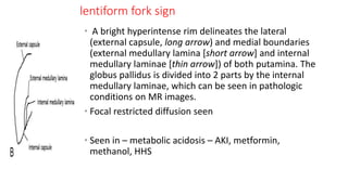 lentiform fork sign
• A bright hyperintense rim delineates the lateral
(external capsule, long arrow) and medial boundaries
(external medullary lamina [short arrow] and internal
medullary laminae [thin arrow]) of both putamina. The
globus pallidus is divided into 2 parts by the internal
medullary laminae, which can be seen in pathologic
conditions on MR images.
• Focal restricted diffusion seen
• Seen in – metabolic acidosis – AKI, metformin,
methanol, HHS
 