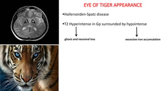 EYE OF TIGER APPEARANCE
Hallervorden-Spatz disease
T2 Hyperintense in Gp surrounded by hypointense
gliosis and neuronal loss excessive iron accumulation
 