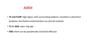 ADEM
• T2 and FLAIR: high signal, with surrounding oedema -situated in subcortical
locations; the thalami and brainstem can also be involved
• T1 C+ (Gd): open ring sign
• DWI: there can be peripherally restricted diffusion
 