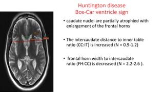 Huntington disease
Box-Car ventricle sign
• caudate nuclei are partially atrophied with
enlargement of the frontal horns
• The intercaudate distance to inner table
ratio (CC:IT) is increased (N = 0.9-1.2)
• frontal horn width to intercaudate
ratio (FH:CC) is decreased (N = 2.2-2.6 ).
 