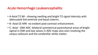 Acute Hemorrhagic Leukoencephalitis
• A-Axial T2 WI - showing swelling and bright T2 signal intensity with
attenuated 3rd ventricle and basal cisterns.
• B- Axial CE MRI -no evident post-contrast enhancement.
• C- Axial - DWI ADC -bilateral symmetrical parenchymal areas of bright
sigmal in DWI and low values in ADC maps also seen involving the
corpus callosum and the cerebrellar white matter.
 