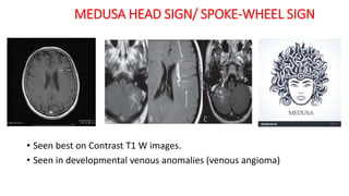 MEDUSA HEAD SIGN/ SPOKE-WHEEL SIGN
• Seen best on Contrast T1 W images.
• Seen in developmental venous anomalies (venous angioma)
 