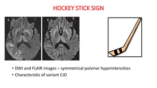 HOCKEY STICK SIGN
• DWI and FLAIR images – symmetrical pulvinar hyperintensities
• Characteristic of variant CJD
 