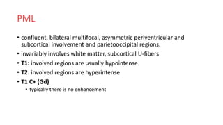 PML
• confluent, bilateral multifocal, asymmetric periventricular and
subcortical involvement and parietooccipital regions.
• invariably involves white matter, subcortical U-fibers
• T1: involved regions are usually hypointense
• T2: involved regions are hyperintense
• T1 C+ (Gd)
• typically there is no enhancement
 