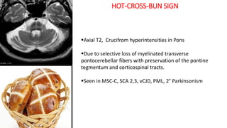 HOT-CROSS-BUN SIGN
Axial T2, Crucifrom hyperintensities in Pons
Due to selective loss of myelinated transverse
pontocerebellar fibers with preservation of the pontine
tegmentum and corticospinal tracts.
Seen in MSC-C, SCA 2,3, vCJD, PML, 2° Parkinsonism
 