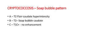 CRYPTOCOCCOSIS – Soap bubble pattern
• A – T2 Flair-caudate hyperintensity
• B – T2– Soap bubble caudate
• C – T1C+ - no enhancement
 