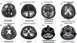 ALEXANDER X-linked ALD
KEARNS-SAYRE
SYNDROME (C
MLD
JUVENILE NCL VWMD
CEREBROTENDINOUS
XANTHOMATOSIS
duplication of LMNB1
DIFFUSE
MILD
 