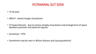 PUTAMINAL SLIT SIGN
• T2 W axial
• MSA-P - lateral margin of putamen
• T2 hyperintensity - due to severe atrophy of putamen and enlargement of space
between putamen and external capsule
• Sensitivity ~ 97%
• Sometimes may be seen in Wilson disease also (young patients)
 