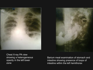 Heterogeneous Opacity Imaging abdomen trauma diaphragmatic trauma part 7 Dr Ahmed Esawy | PDF