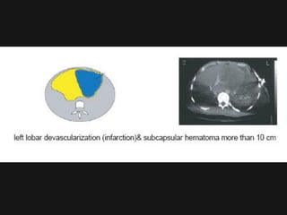 Devascularization Ct Imaging abdomen trauma liver part 2 Dr Ahmed Esawy | PDF