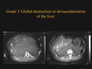 Devascularization Ct Imaging abdomen trauma liver part 2 Dr Ahmed Esawy | PDF