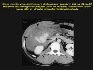 Imaging abdomen trauma mesenteric bowel trauma part 6 Dr Ahmed 