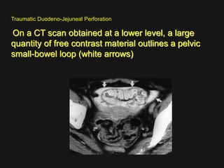 Imaging abdomen trauma mesenteric bowel trauma part 6 Dr Ahmed 