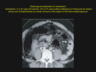 Imaging abdomen trauma mesenteric bowel trauma part 6 Dr Ahmed Esawy | PPT