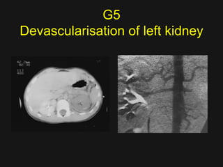 Devascularization Ct Imaging abdomen trauma renal part 5 Dr Ahmed Esawy | PDF