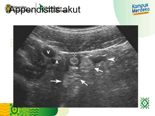 imaging acute appendicitisss.ppt