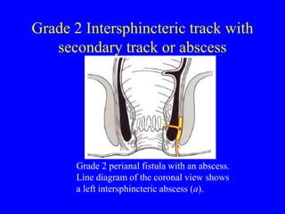 Imaging of Anal Fistulae and perianal abscesses | PPT