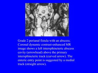 Imaging of Anal Fistulae and perianal abscesses | PPT